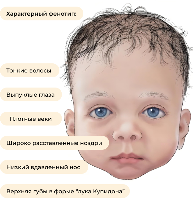 Синдром нунан фото детей